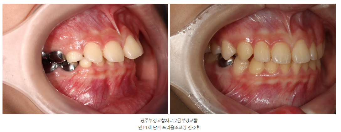 광주부정교합치료 2급 부정교합을 개선하는 교정사례