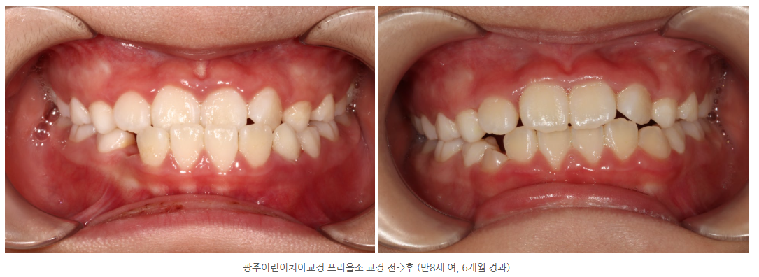 광주어린이치아교정 교정전문의 프리올소 교정 어떻게 할까요?