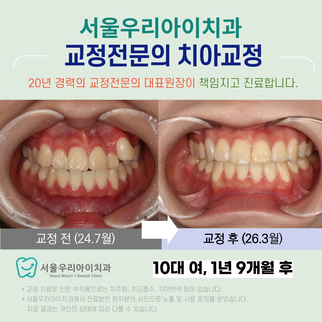 수완동 교정치과 후회없는 교정을 위한 년 경력의 교정전문의 진료...