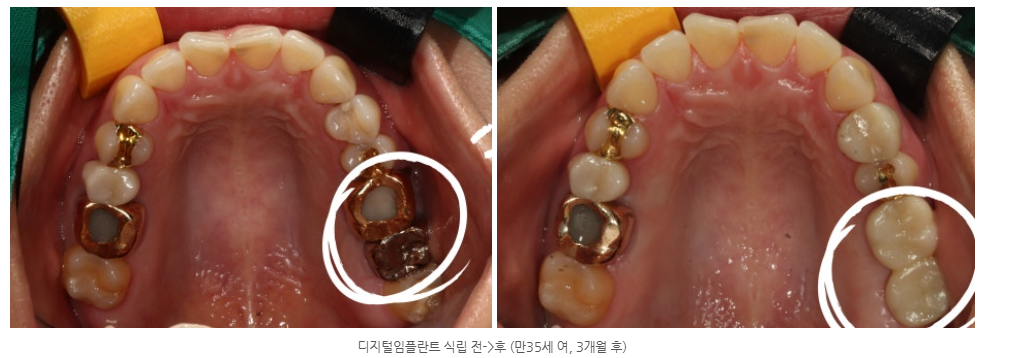 광주광역시에서 30대가 임플란트 받을 수 있는 치과는 어디일까요?