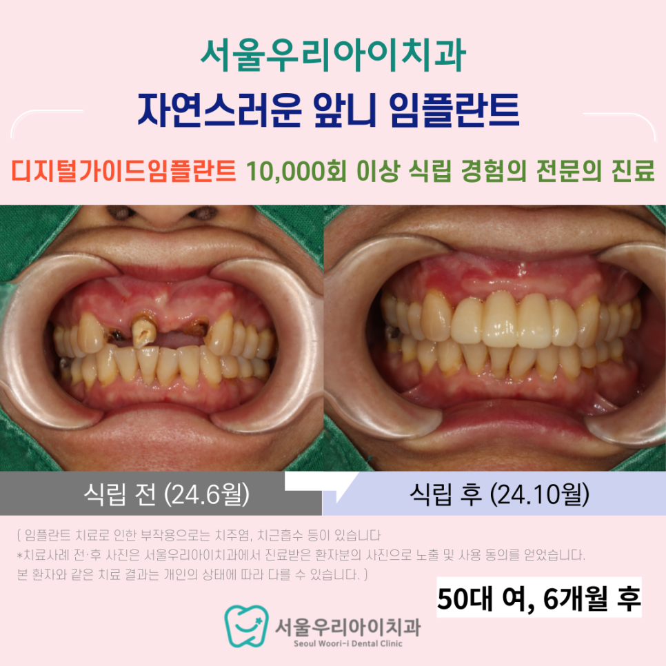 수완지구 앞니 임플란트 예쁘게 만들어드리는 치과에서