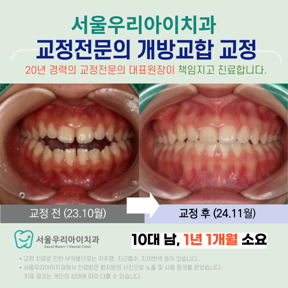 개방교합은 무엇인가요? 광주 교정전문의가 개방교합을 정상교합으로...