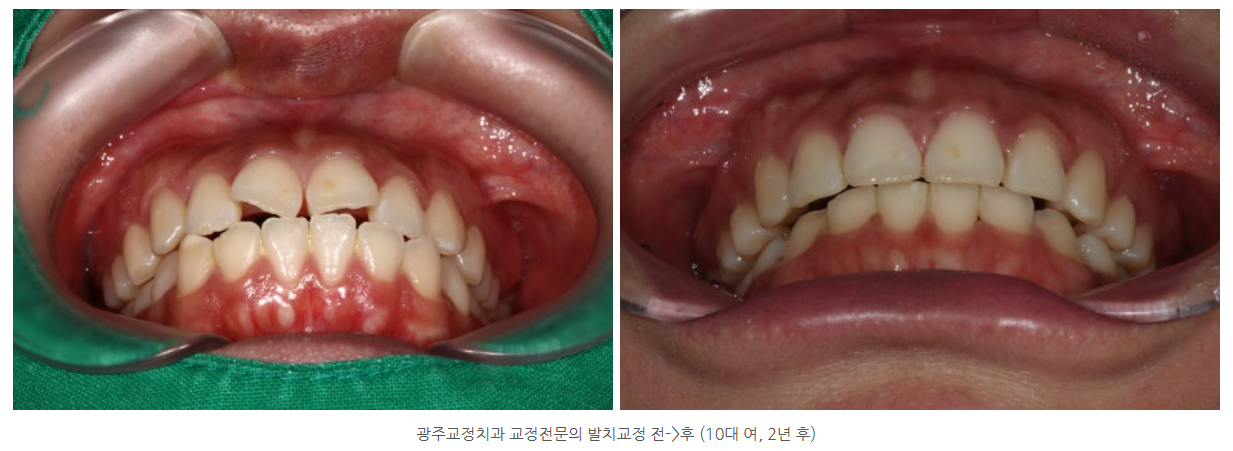 광주에서 치아교정하고 싶은 10대 청소년들, 부모님들 필독!!