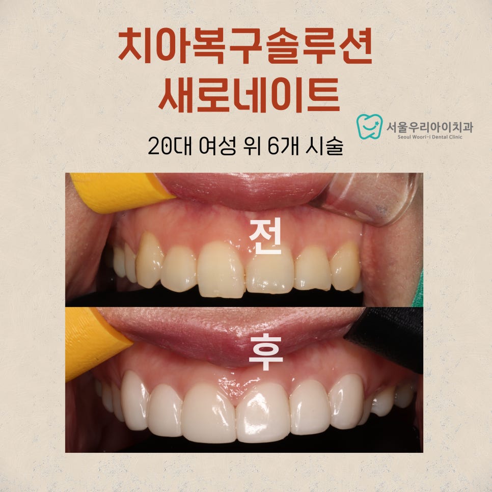 앞니 두 개중 한 개만 짧거나 크기가 다를 때 치료하는 방법
