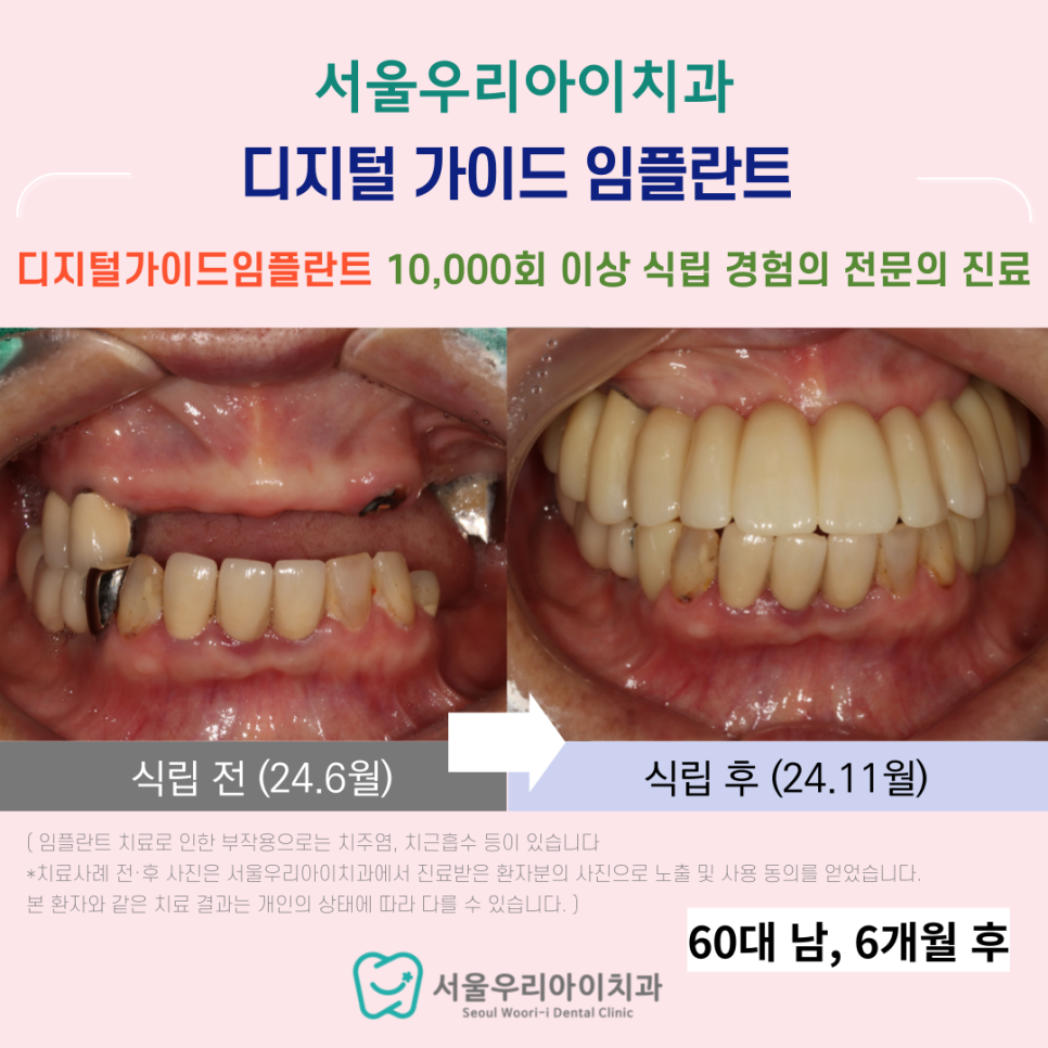 광주 윗니 임플란트 전체 임플란트가 가능한 서울우리아이치과에서