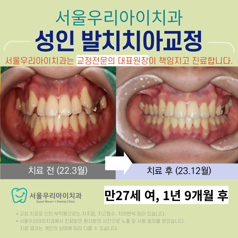 광산구에서 성인 발치 치아교정이 가능한 교정전문의 치과를 찾는다면?