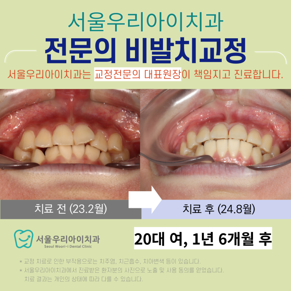 광주광역시 교정전문의 교정진료 잘하는 치과는?