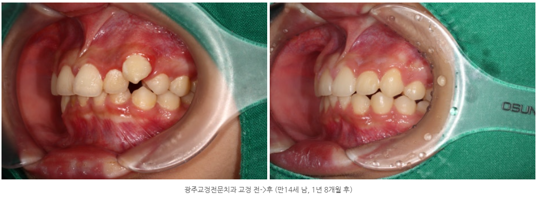 광주치아교정 시작해야 하는 나이는 몇살부터인가요?