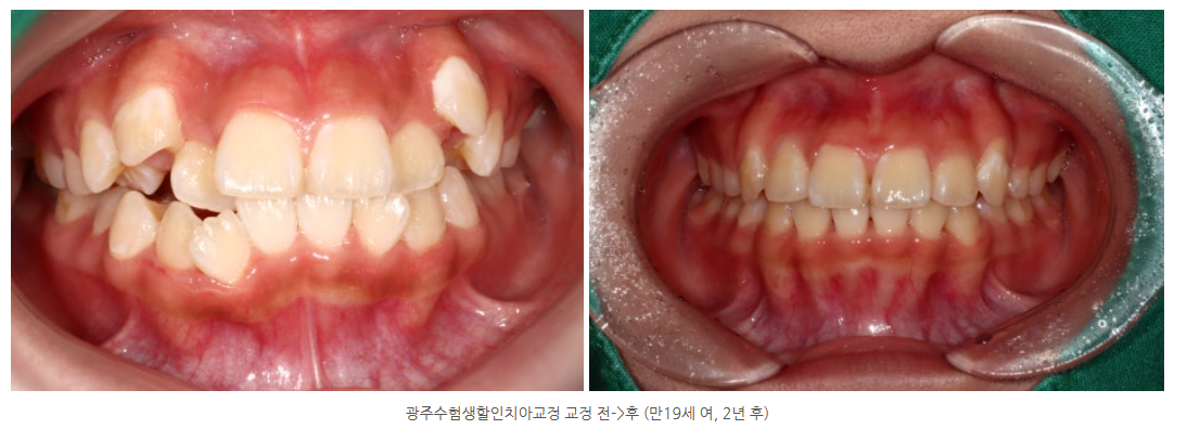 수험생 치아교정 중학생, 고등학생 치아교정 가능한 광주 야간교정...
