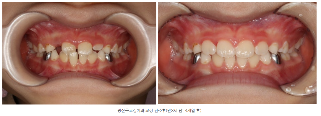광산구교정치과 광주아이프리올소 교정으로 반대교합 개선하기
