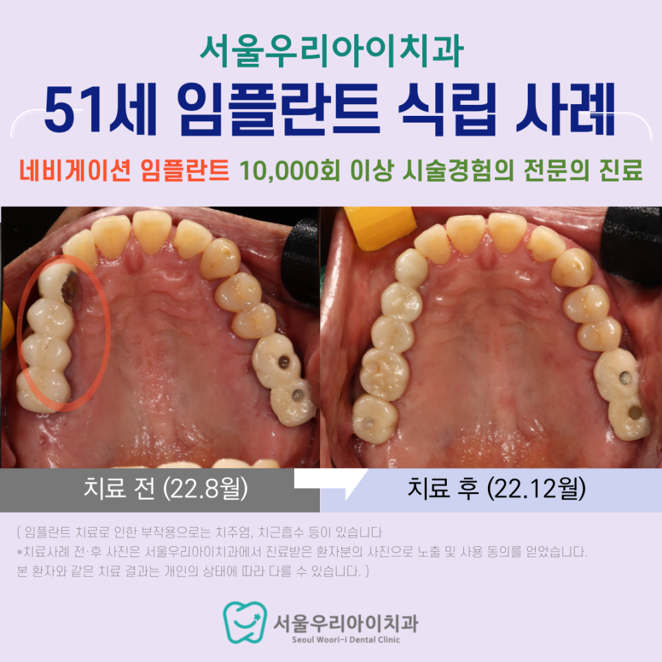 광주 상악동거상술은 무엇인가요? 광주 임플란트 치과에서 상악동거...