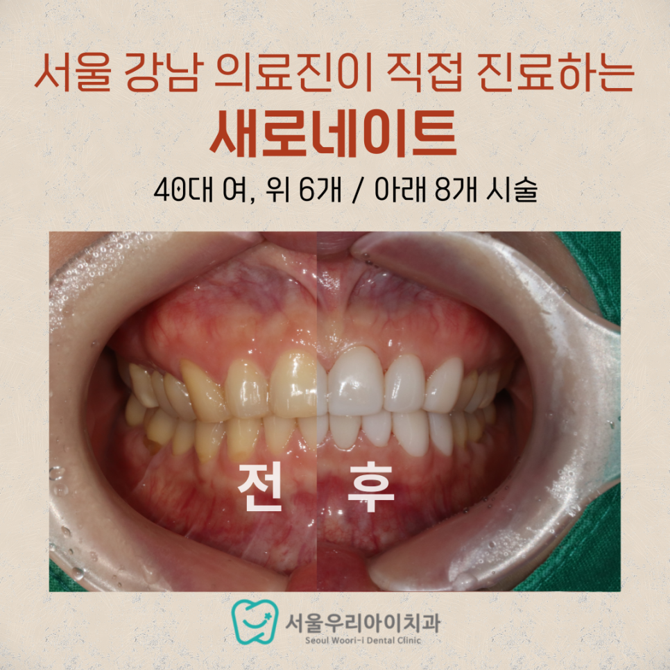 광주에서 서울 강남까지 가지 않아도 되는 라미네이트 비결은?