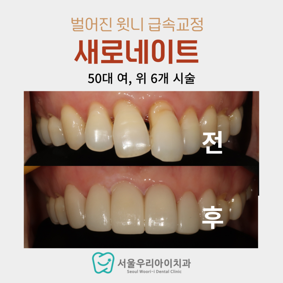 삐뚤빼뚤한 치아 때문에 자신감이 없는 분들이라면 추천하는 치료법...