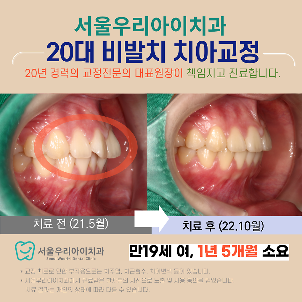 광주 교정치과에서 20대 치아교정을 하는 방법은?