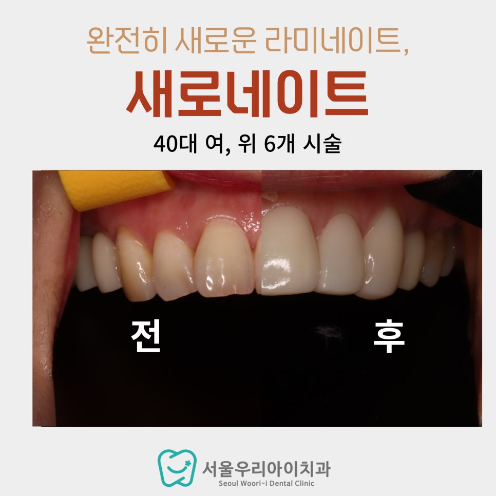 커피, 와인 좋아하는 20대 여성에게 추천하는 치아미백 방법은?