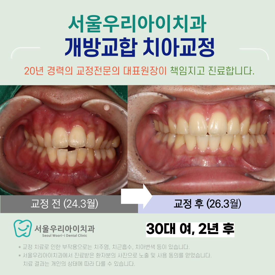 광주 개방교합 성인이 된 후에 치아교정을 할 때는 꼭 확인해야할...