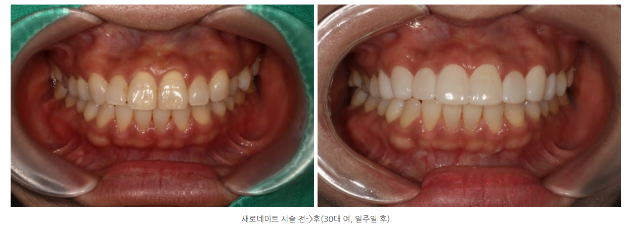 라미네이트 치아 얼마나 깎나요? 라미네이트 부작용이 있을까요?