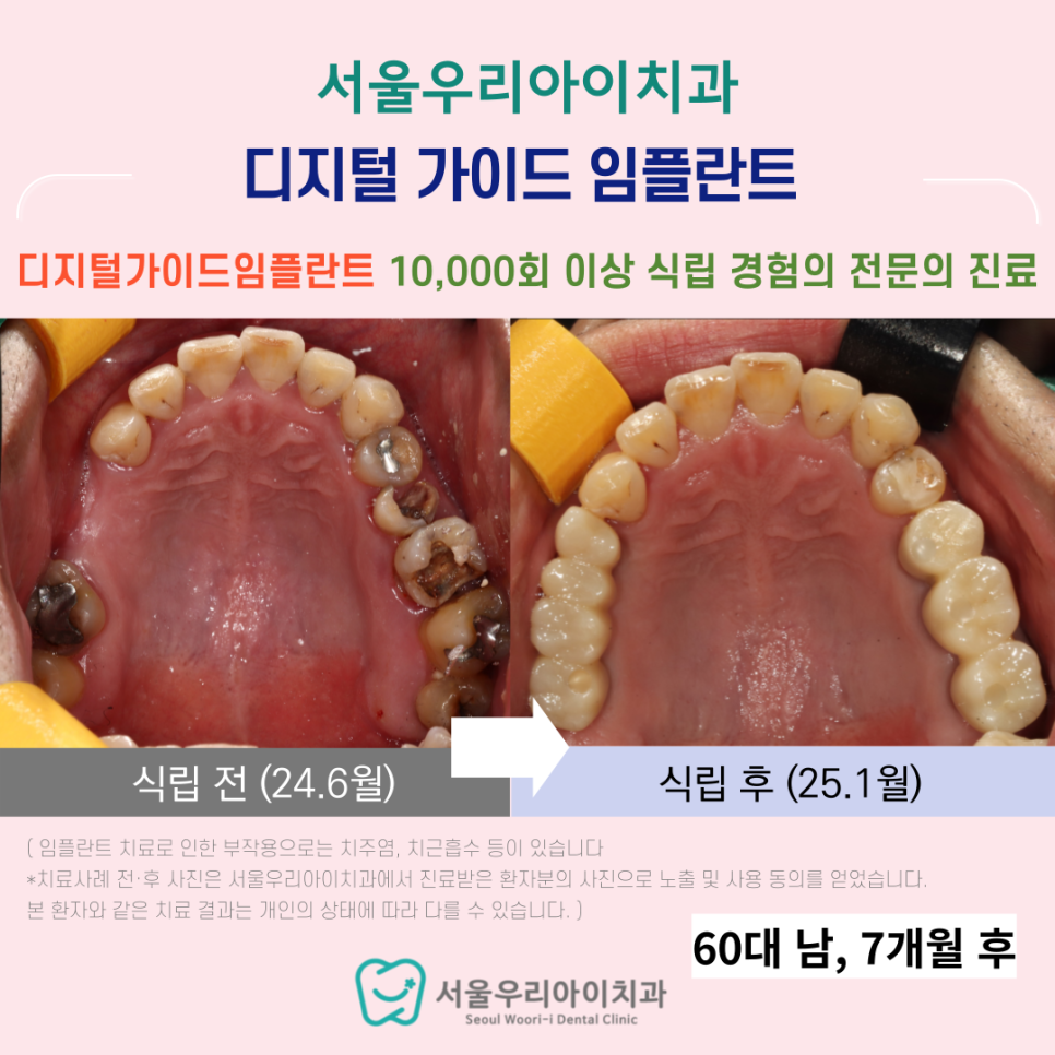 하남동 임플란트 뼈가 부족한 임플란트 잘하는 치과를 찾는다면?