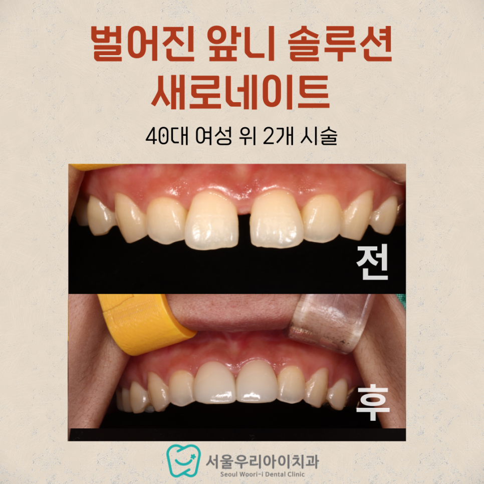 광주광역시에서 앞니 벌어짐 치료를 가장 잘하는 치과는 어딘가요?