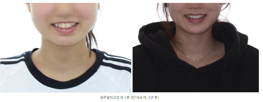 광주교정치과 사랑니발치 교정전문의 대표원장이 직접 하는 곳은?