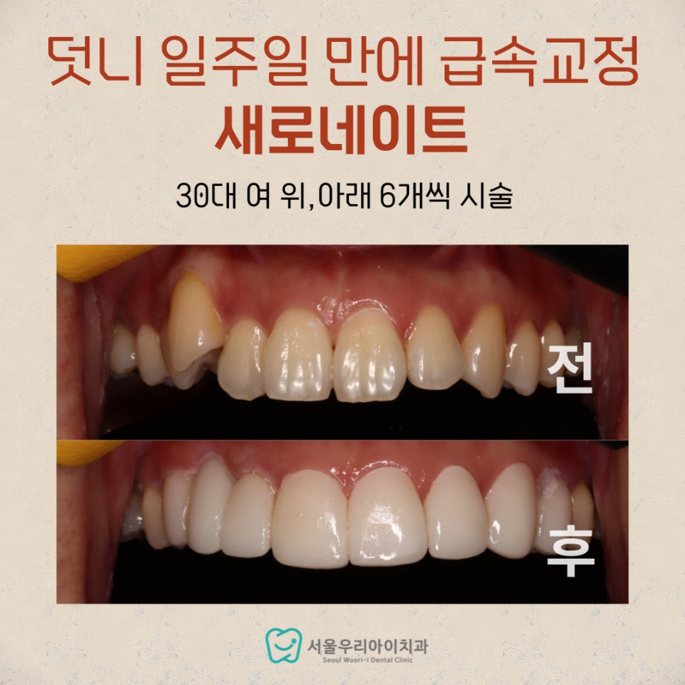 광주에서 급속치아교정으로 덧니 한 개만 해결할 수 있을까요?
