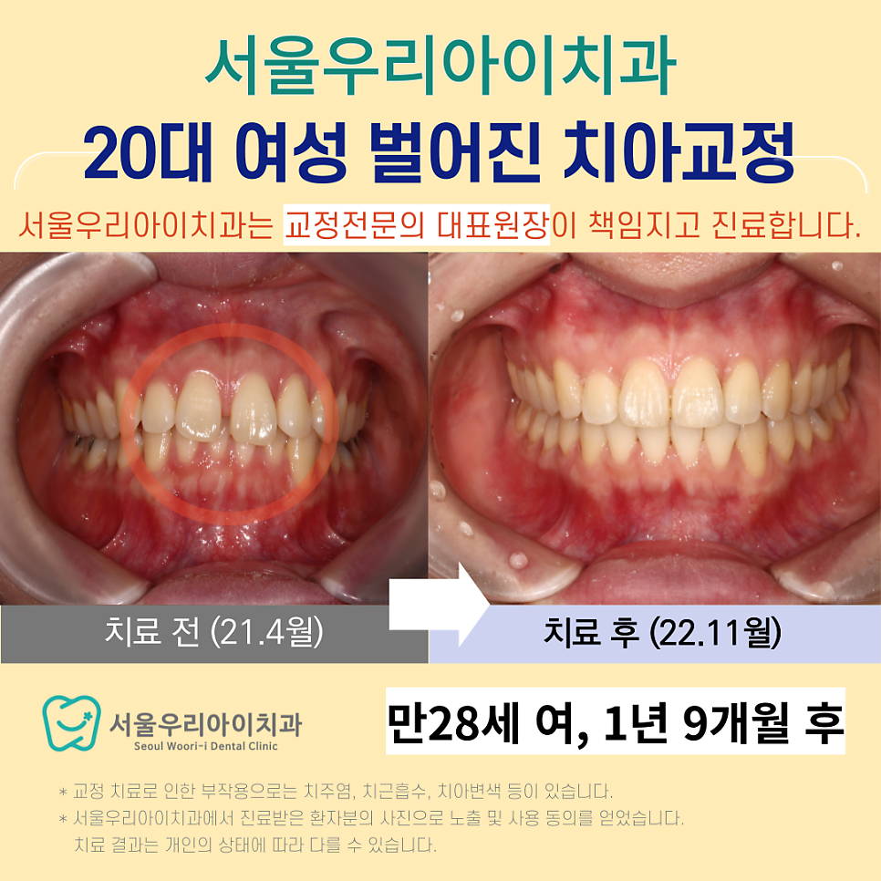 광주 교정치과 벌어진 치아는 어떻게 교정할까요?