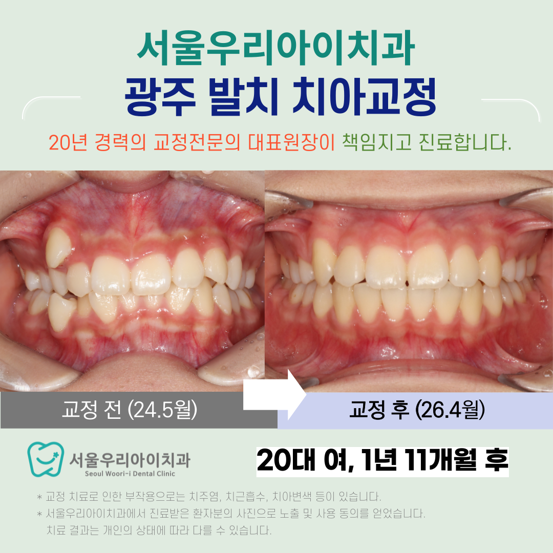 광주 발치교정 발치 꼭 필요한 경우는 언제일까요