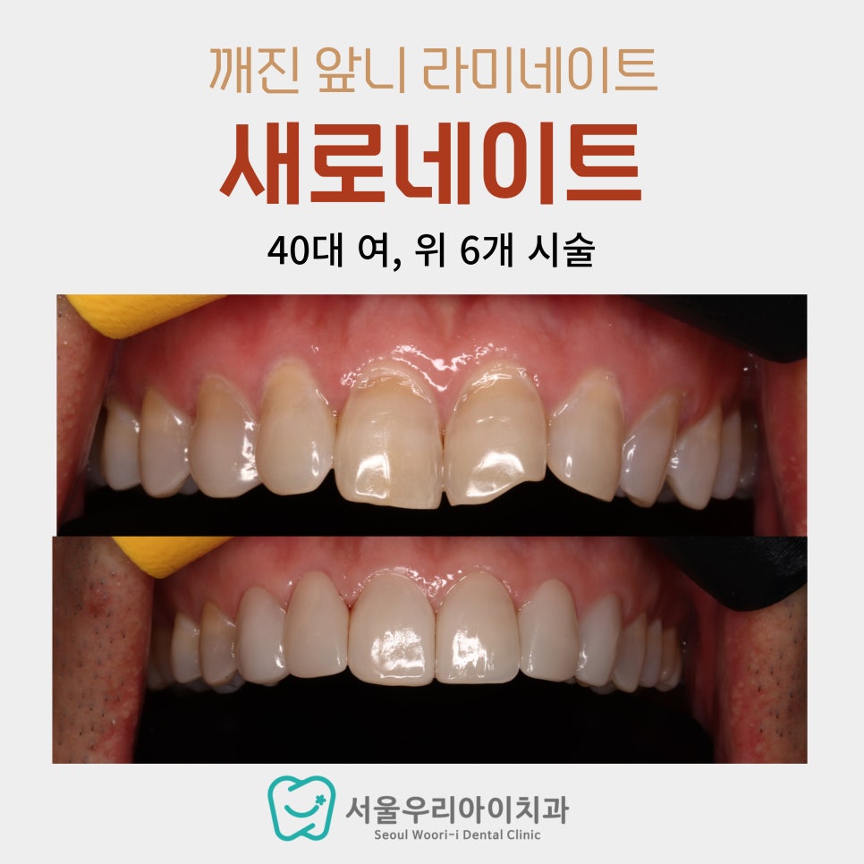 광주에서 깨진 앞니 치료하는 치과 후회하기 싫다면 필독!