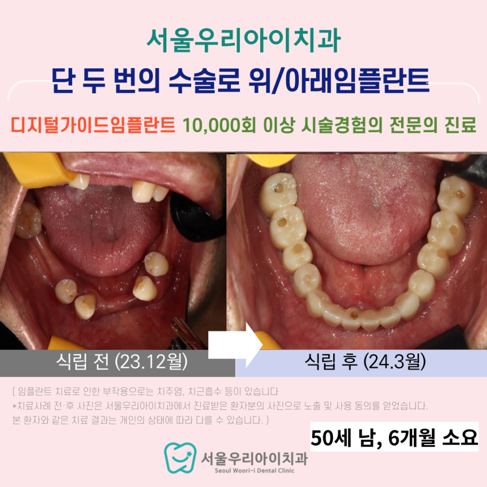 광산구 임플란트 치과에서 단 두 번의 수술만으로 전체 임플란트를...