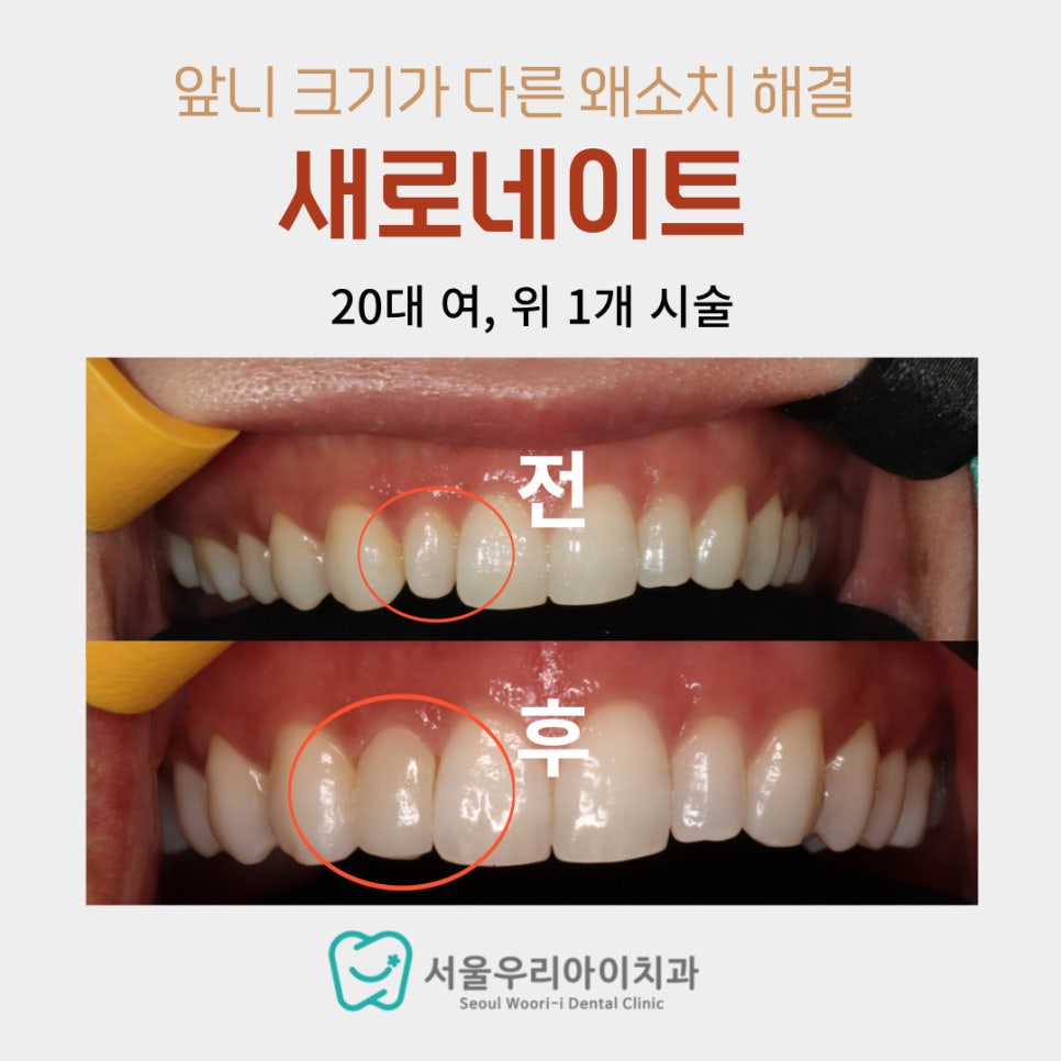 광주에서 앞니 1개만 라미네이트 할 수 있나요? 왜소치 1개만...