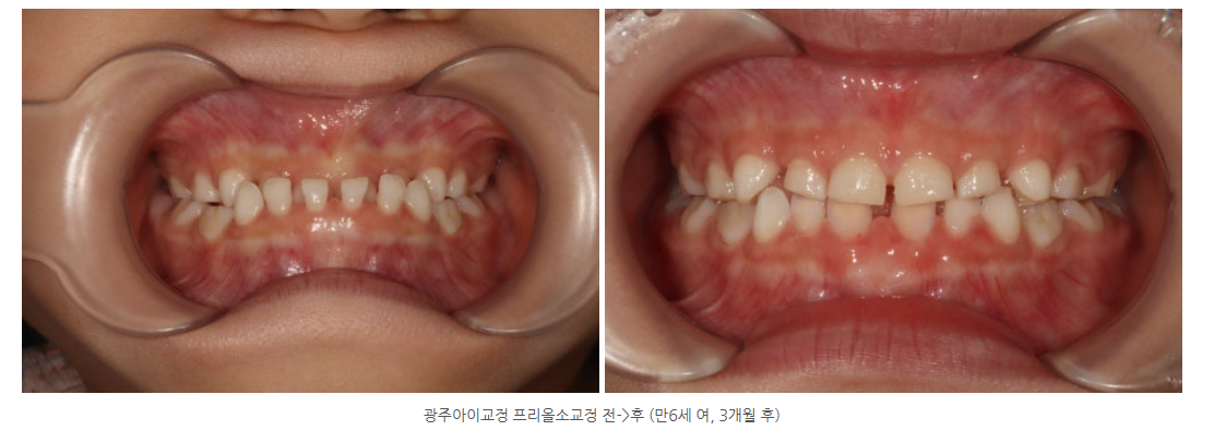 광주광역시 프리올소 공식인증치과가 궁금하시다면?