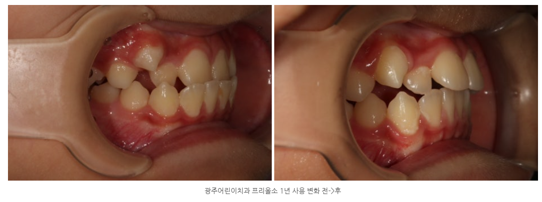 광산구교정치과 프리올소1년간 사용변화