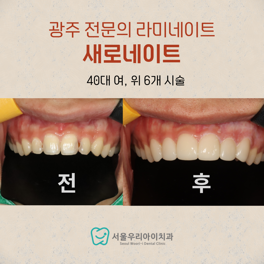 광주 라미네이트 앞니가 충치로 변색이 되거나 구멍이 뚫렸다면 추...