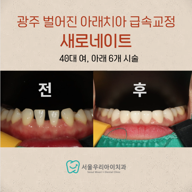 광주라미네이트 아래치아 벌어져 있을 때 급속교정으로 추천하는 이...