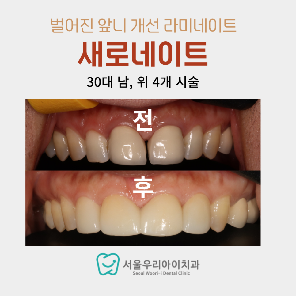 광주 성인 남녀 앞니가 벌어져서 급속으로 교정하는 곳을 찾아요