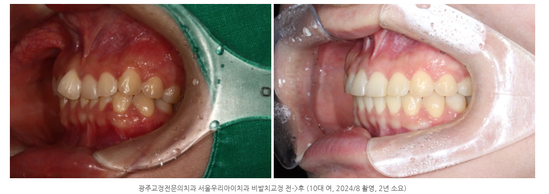 믿을 수 있는 광주 교정치과를 찾으신다면? 필독!
