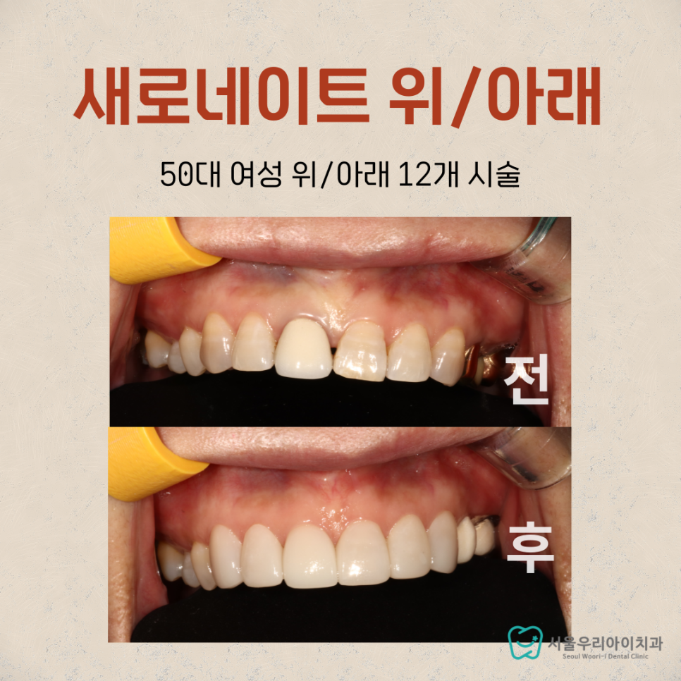 중년 라미네이트 시술로 누렇고 변색된 치아를 환하게 반영구치아미백