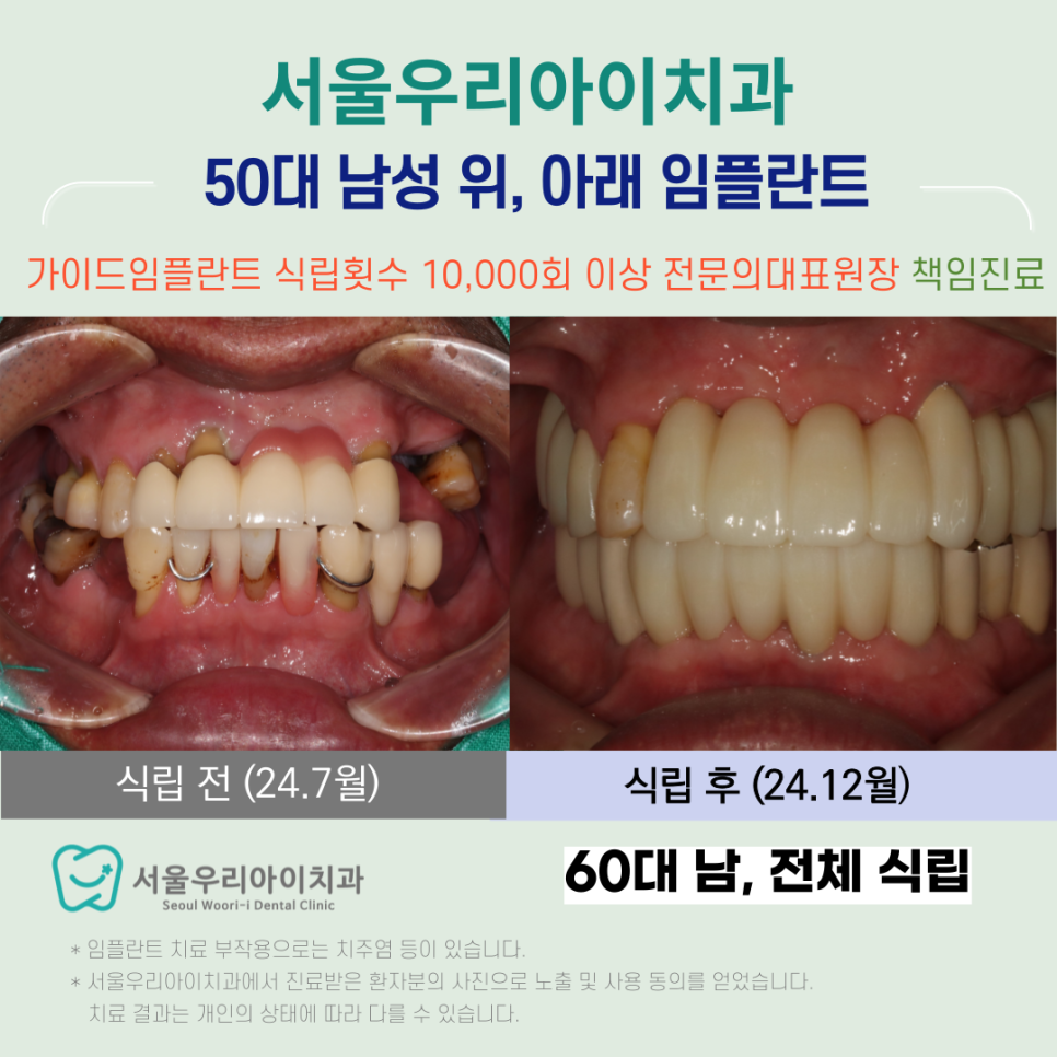 수완동 전체임플란트 치과에서 어려운 임플란트를 성공하는 비결은?