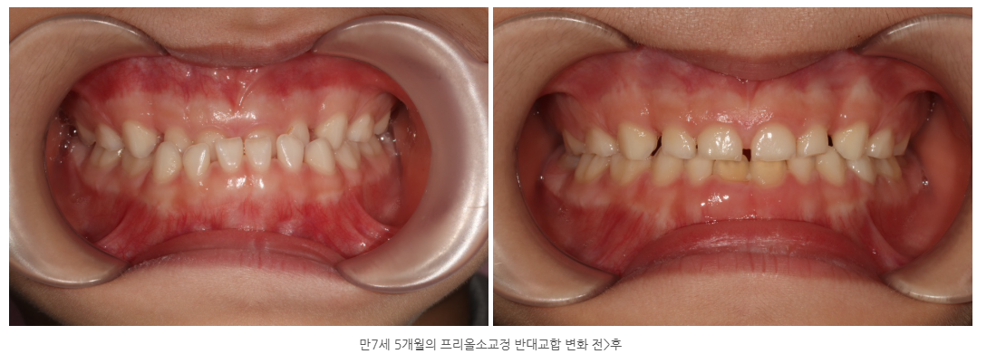 광주 소아치과 프리올소 교정 어떻게 바뀌나요?