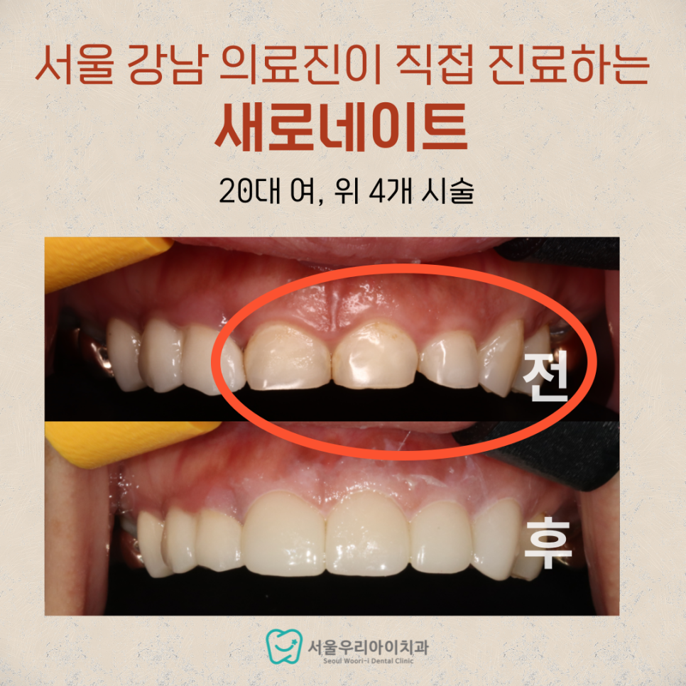 앞니 라미네이트 4개만 해도 되나요?