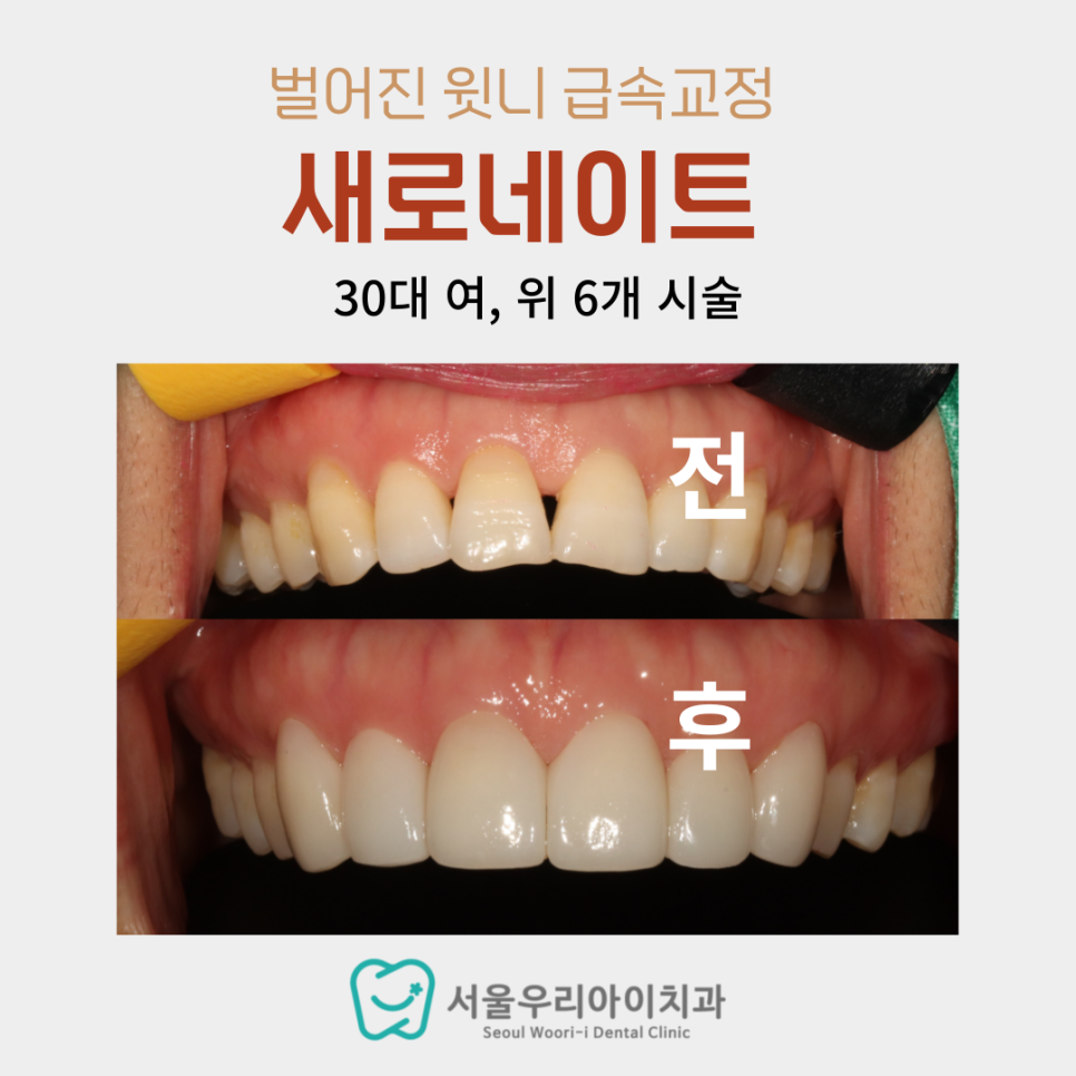 앞니만 살짝 벌어졌는데 전체 치아교정 꼭 필요한가요?