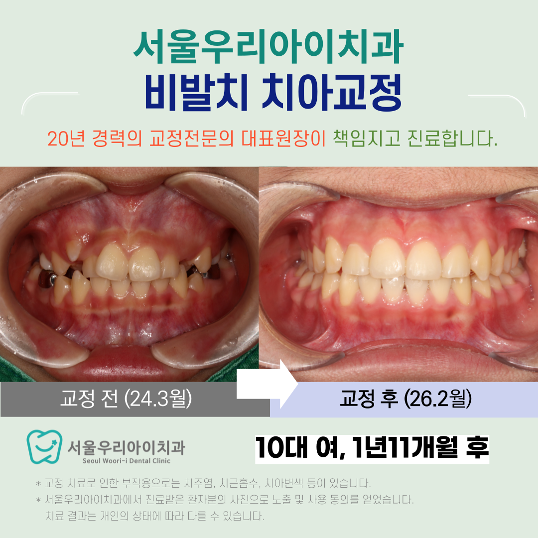 광주 교정치과 검증된 교정전문의 진료가 필요하다면