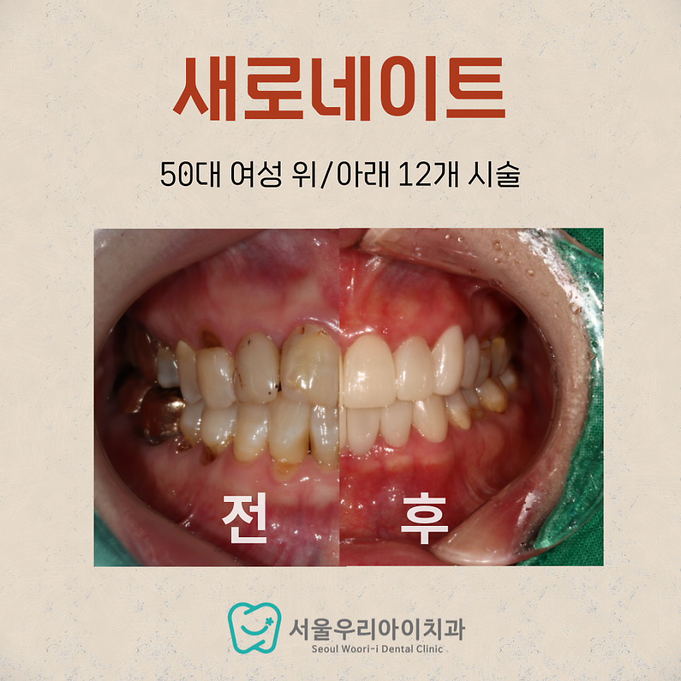 광주광역시에서 서울 강남 의료진이 진료하는 유일한 라미네이트 치과는?