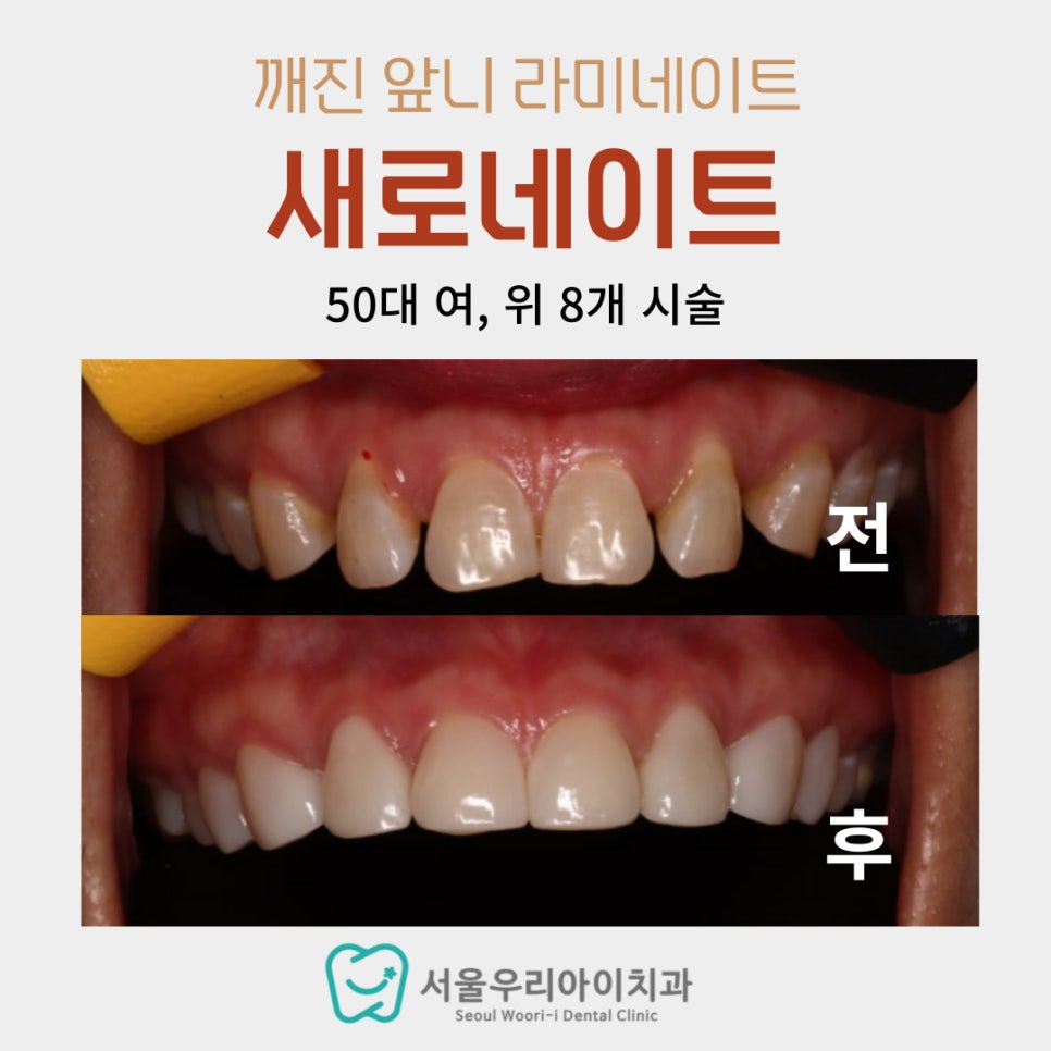 앞니가 깨졌을 때 치료법? 앞니가 깨진 것을 어떻게 치료하나요?