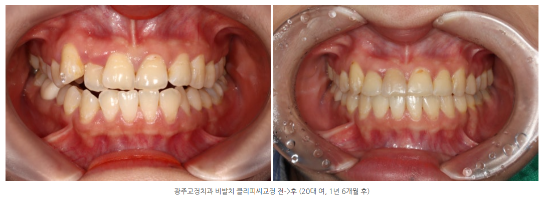 광산구 교정치과에서 비발치교정과 사랑니발치, 충치치료를 함께 진...