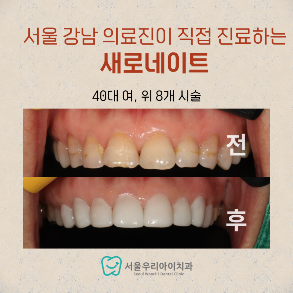 누런 이가 고민인 40대 이상 꼭 읽어봐야 하는 이유