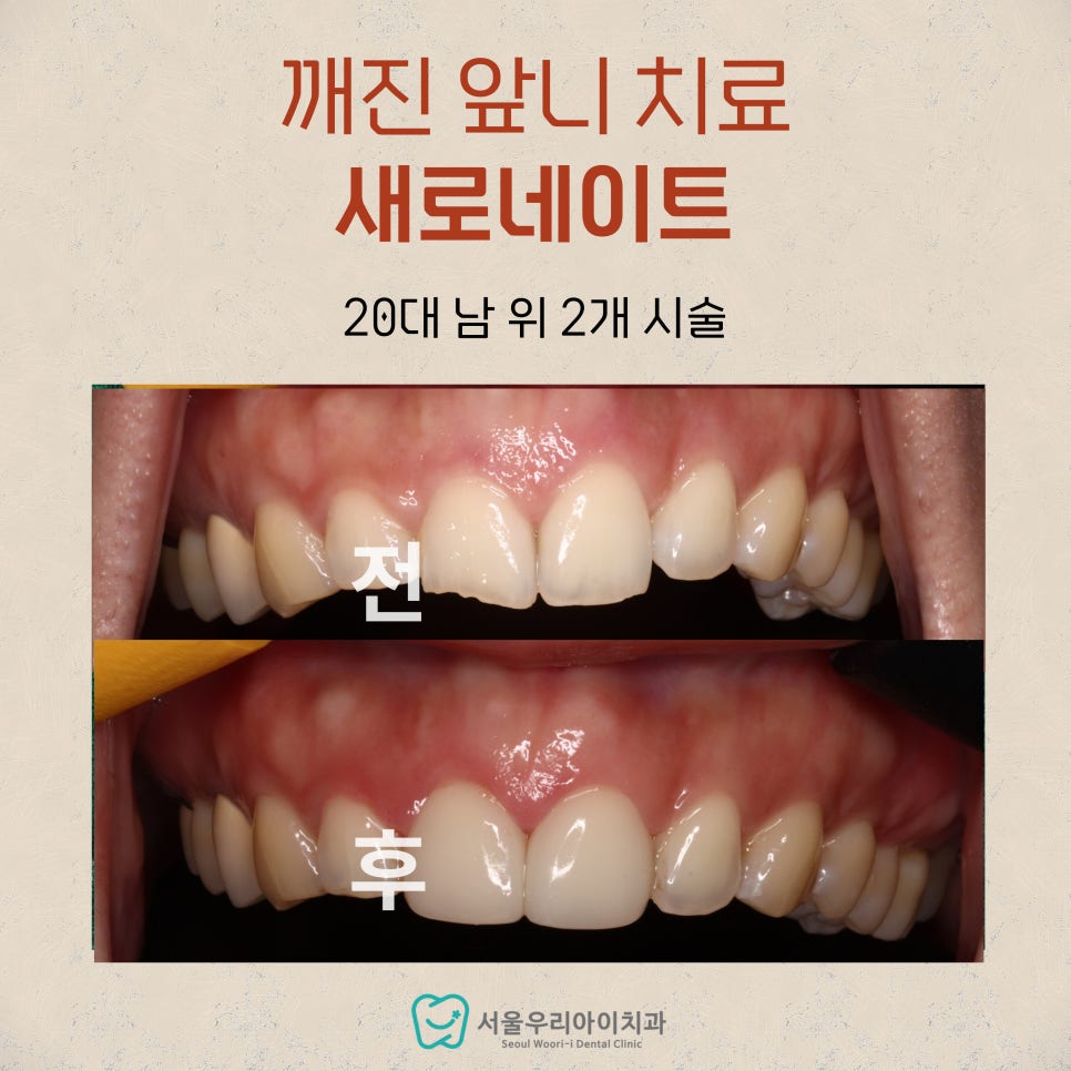 광주에서 앞니 깨져서 고민인 20대 이상 성인이라면 읽어보세요!