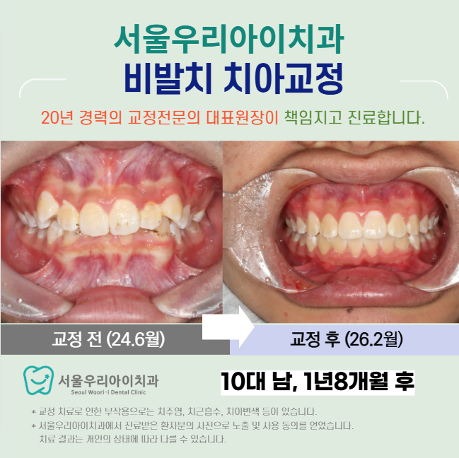 광산구 교정치과에서 교정전문의의 대 청소년 치아교정이 특별한 이...