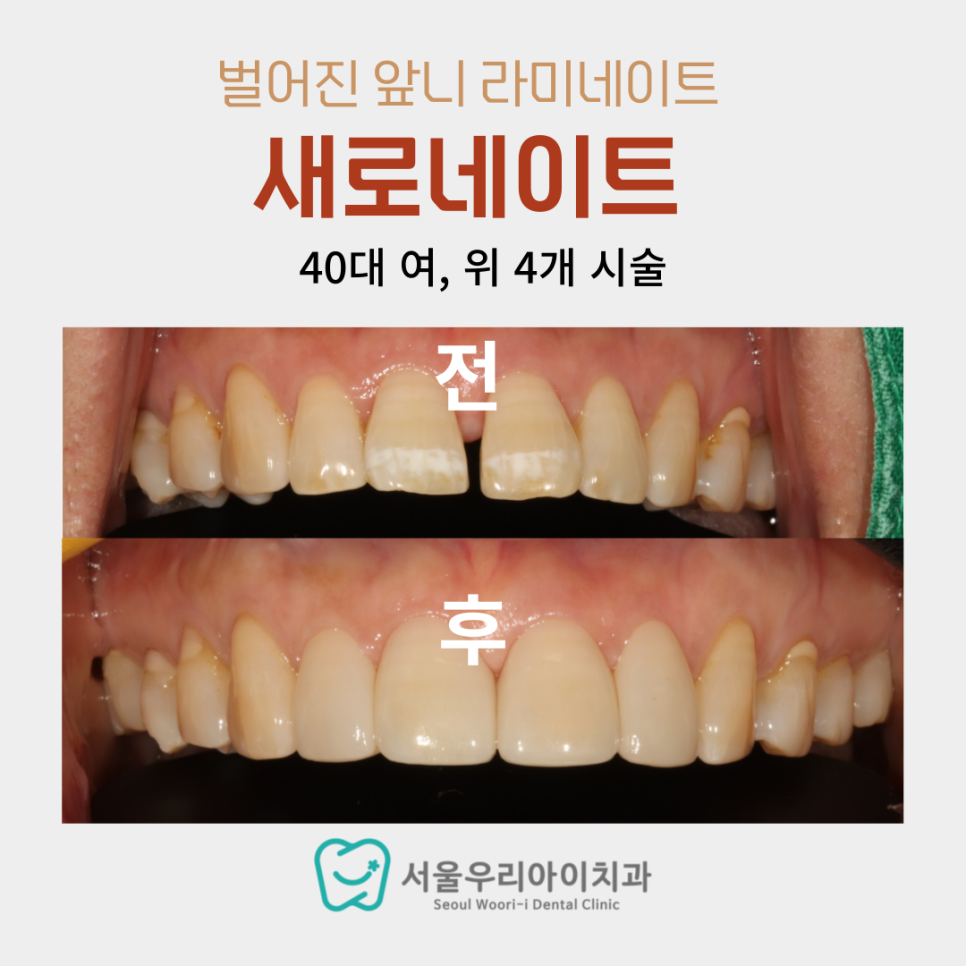 얼룩덜룩한 앞니를 해결하는 광주 라미네이트 치과의 방법은?