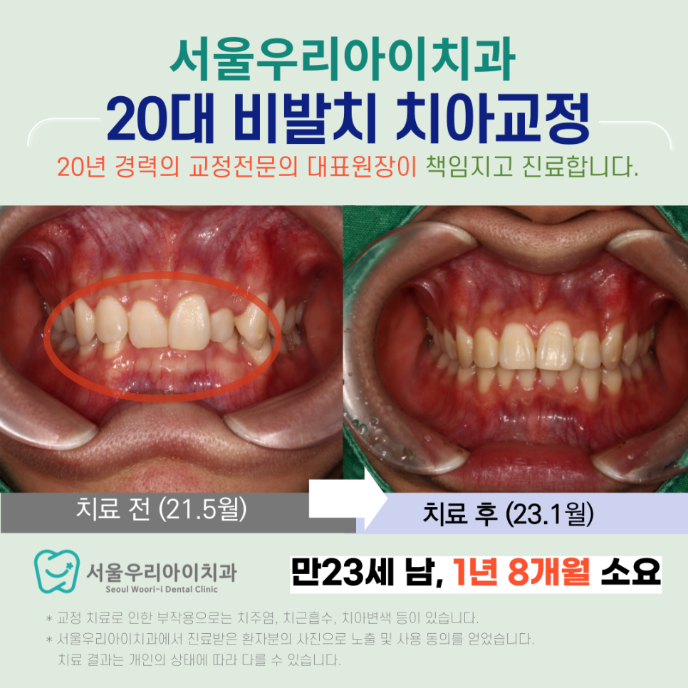 광주 교정치과 비발치 성인치아교정으로 미소를 완성하는 비결은?